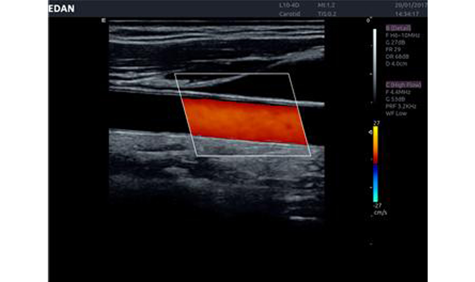 LX3 Trolley Color Ultrasound7