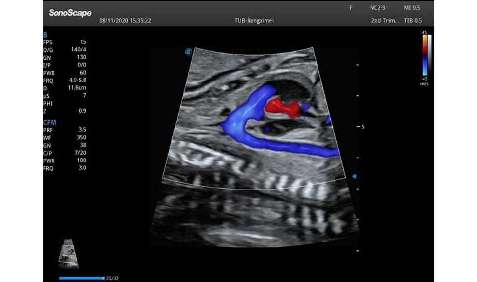 S22 Trolley Color Ultrasound